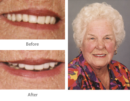 Before and After Dental Treatment Case