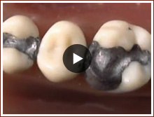 Holistic Dentistry Lakewood - Smoking Teeth Video