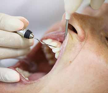 gum disease procedure for gingivitis