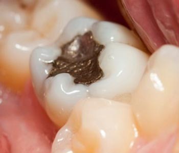 Dr. Scott Stewart at South Lakewood Dental helps to avoid mercury poisoning with composite fillings.