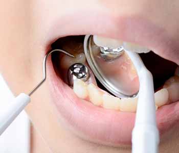 Dr. Scott Stewart at South Lakewood Dental describes the removal of mercury fillings.