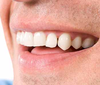 dentist answers, what is gum disease?