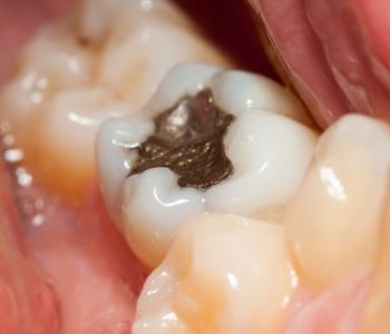 Amalgam removal from Mercury Safe Dentist in Lakewood