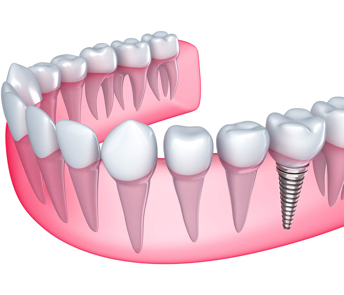Why You Should Consider Dental Implants for Missing Teeth in Lakewood, CO Area