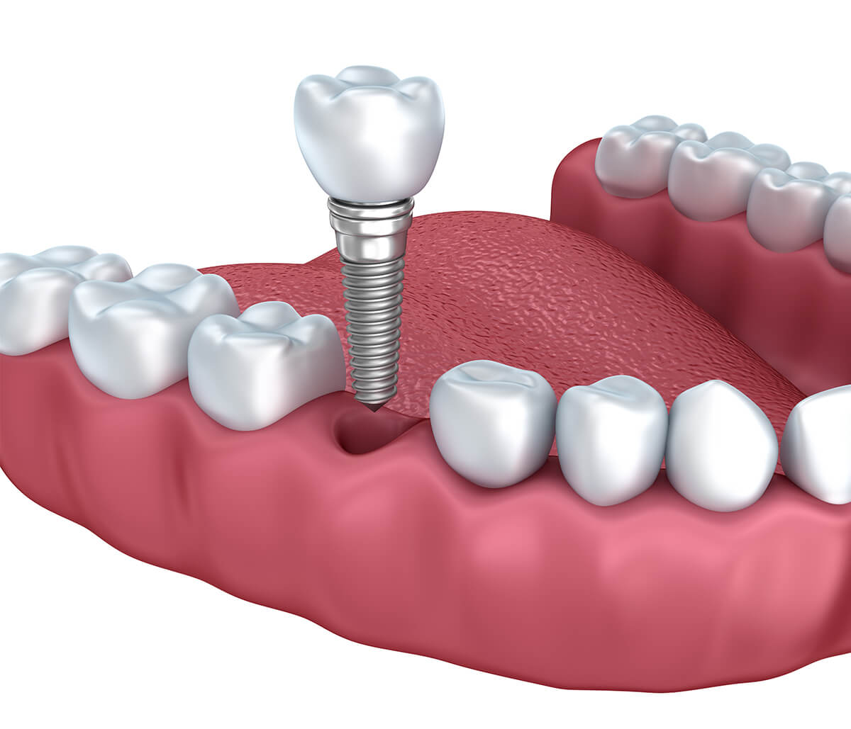 Dental Implant Clinic in Lakewood CO Area