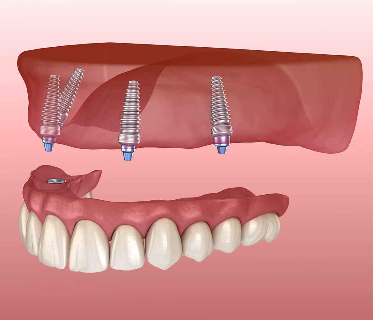 Implant Support Dentures in Lakewood CO Area