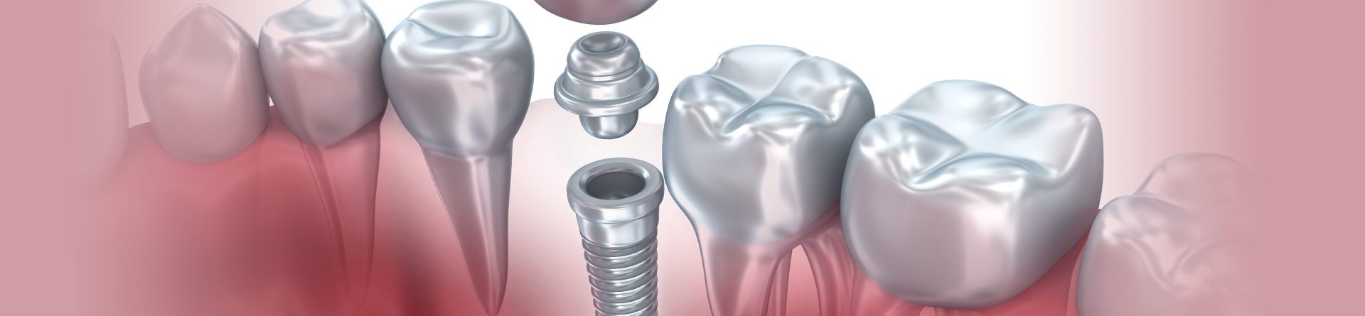 Dental Implants Services at South Lakewood Dental Doing nice tooth restorations